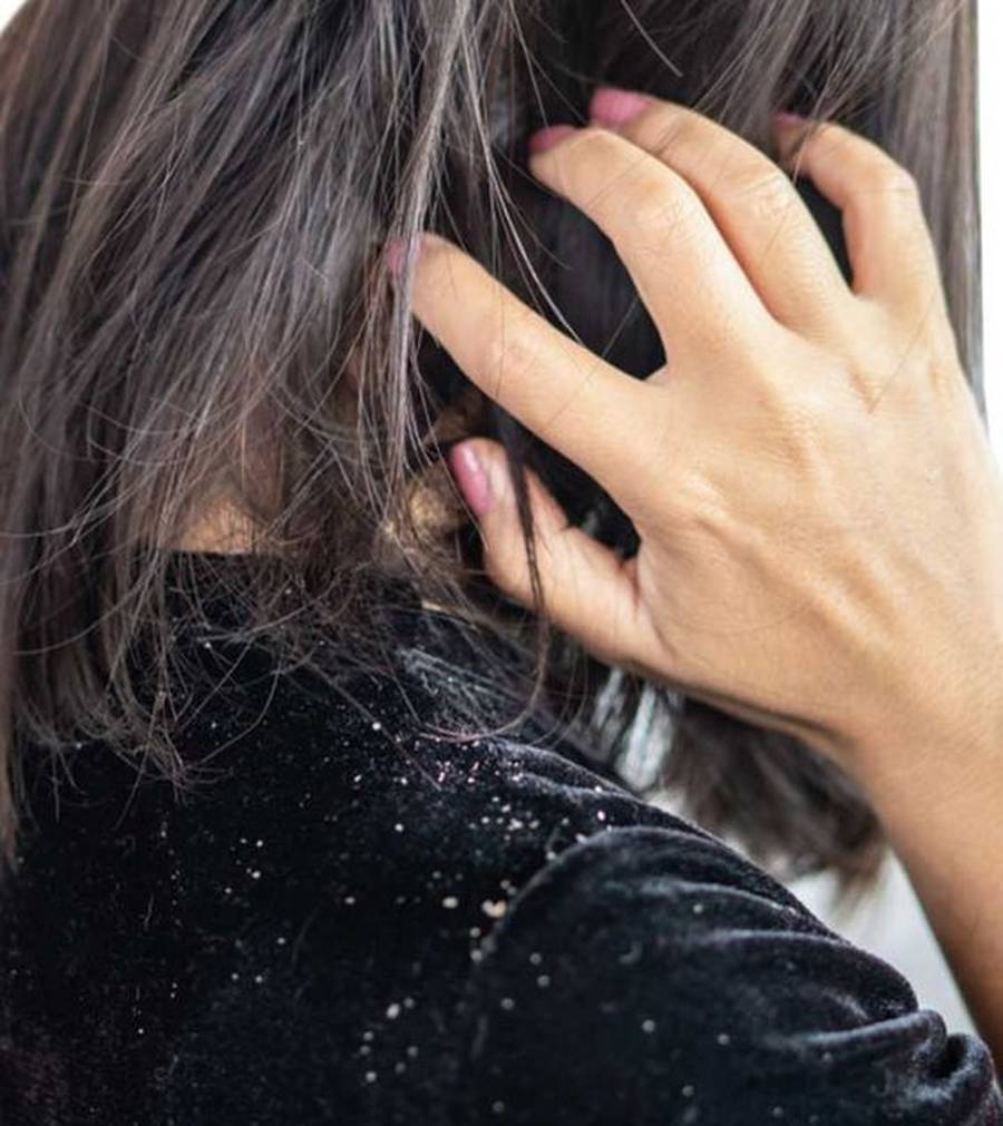  علت شوره سر کمبود کدام ویتامین است 