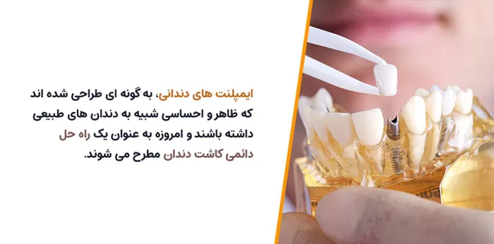چرا ایمپلنت های دندانی می توانند مدت زمان زیادی دوام بیاورند؟